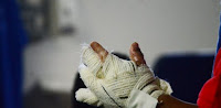 Sesab contabiliza 53 atendimentos a vítimas de queimaduras